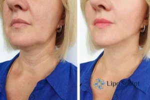 Double chin before and after Hi-Fu treatment 4 Book your double chin treatment Winslow today! We are here to help!