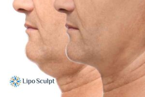 Double chin before and after Hi-Fu treatment 2 Double chin treatment Winslow from Lipo Sculpt - feel more confident today!