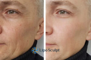 How to Fight Aging Symptoms 3 Fight Aging Symptoms Winslow With HIFU and Morpheus8 Today!