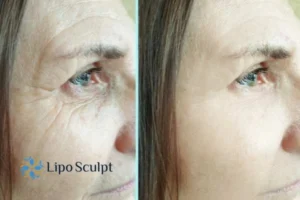 How to Fight Aging Symptoms 2 Do you want to Fight Aging Symptoms Winslow? Contact Lipo Sculpt today!