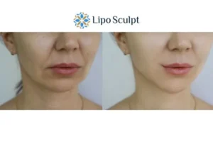 Explaining Total Skin Tightening Treatment And What It Can Do For You 2 Do you want to boost your self confidence? Give Morpheus8 Winslow a try today!