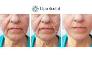 Explaining Total Skin Tightening Treatment And What It Can Do For You 3 Boost your confidence with Morpheus8 Winslow call our team today!