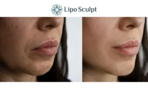 Explaining Total Skin Tightening Treatment And What It Can Do For You 4 Morpheus8 Winslow the best results - call our team today!