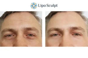 Explaining Total Skin Tightening Treatment And What It Can Do For You 6 Morpheus8 Winslow book in today to find out more!