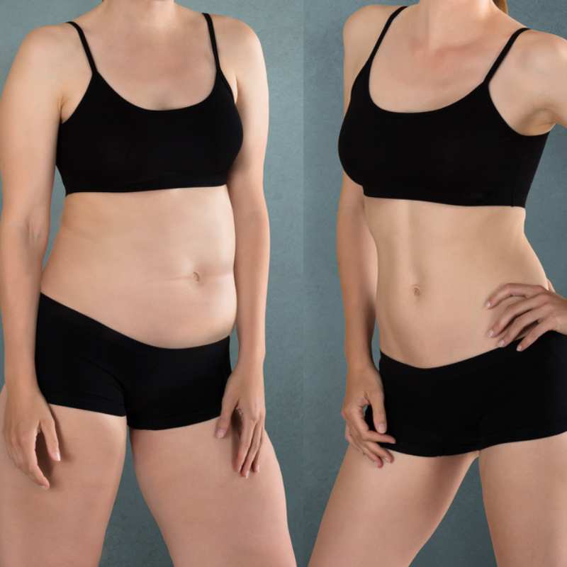 Does Fat Freezing at Home Work? DIY Devices vs Professional Cryolipolysis 2 before and after Cryolipolysis Winslow