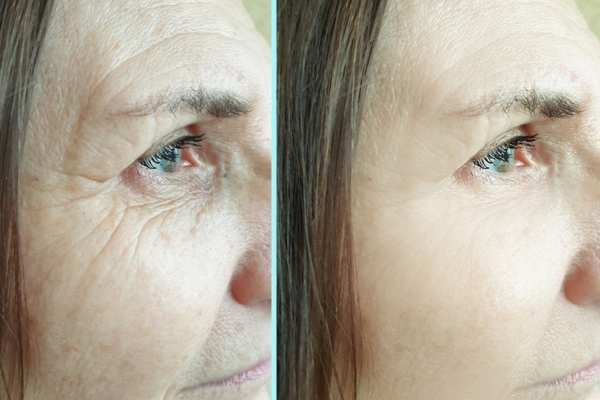 Why Do People Choose HIFU for a Non-Surgical Facelift? 4 How long can HIFU results last Winslow?