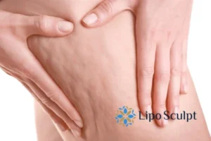 CoolSculpting for Legs: The Innovative Approach to Redefining Your Legs 5 Start your journey today book your coolsculpting treatment Winslow online today!