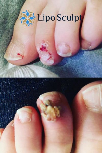 Wart removal customer results from Lipo Sculpt Winslow
