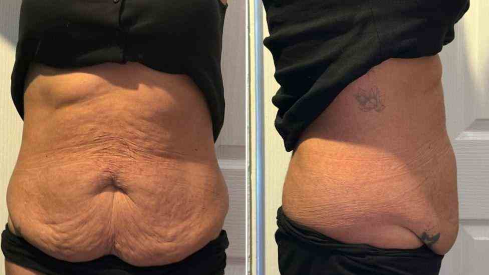 Lost the Weight but Not the Loose Skin? What You Should Know 1 Is It Definitely Loose Skin Winslow?
