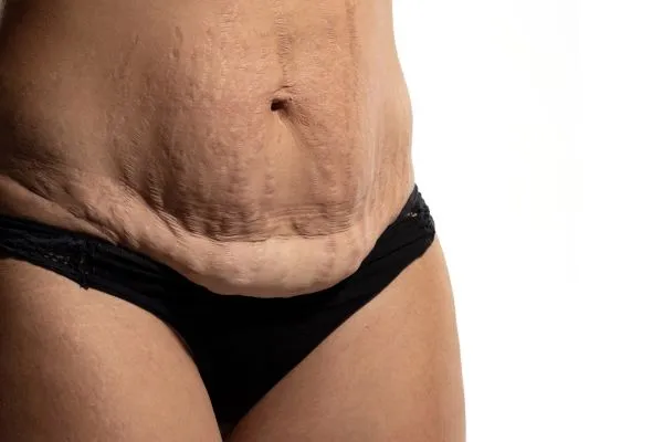 Lost the Weight but Not the Loose Skin? 1 image of womans stomach after weight loss showing loose skin Winslow